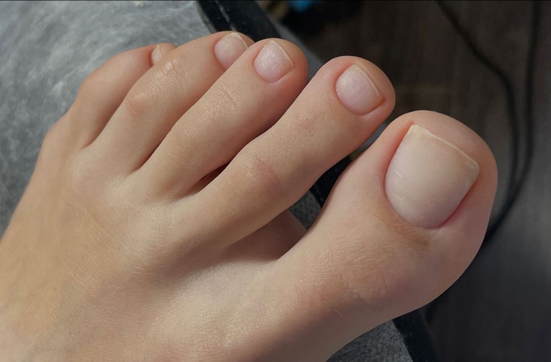 Keryflex Nail Restoration